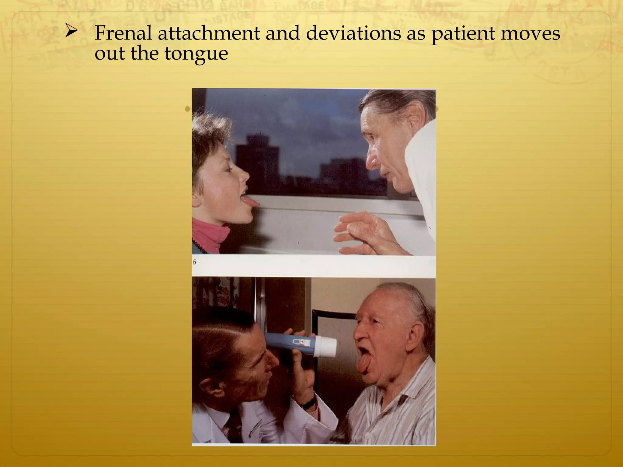  Frenal attachment and deviations as patient moves
out the tongue
 