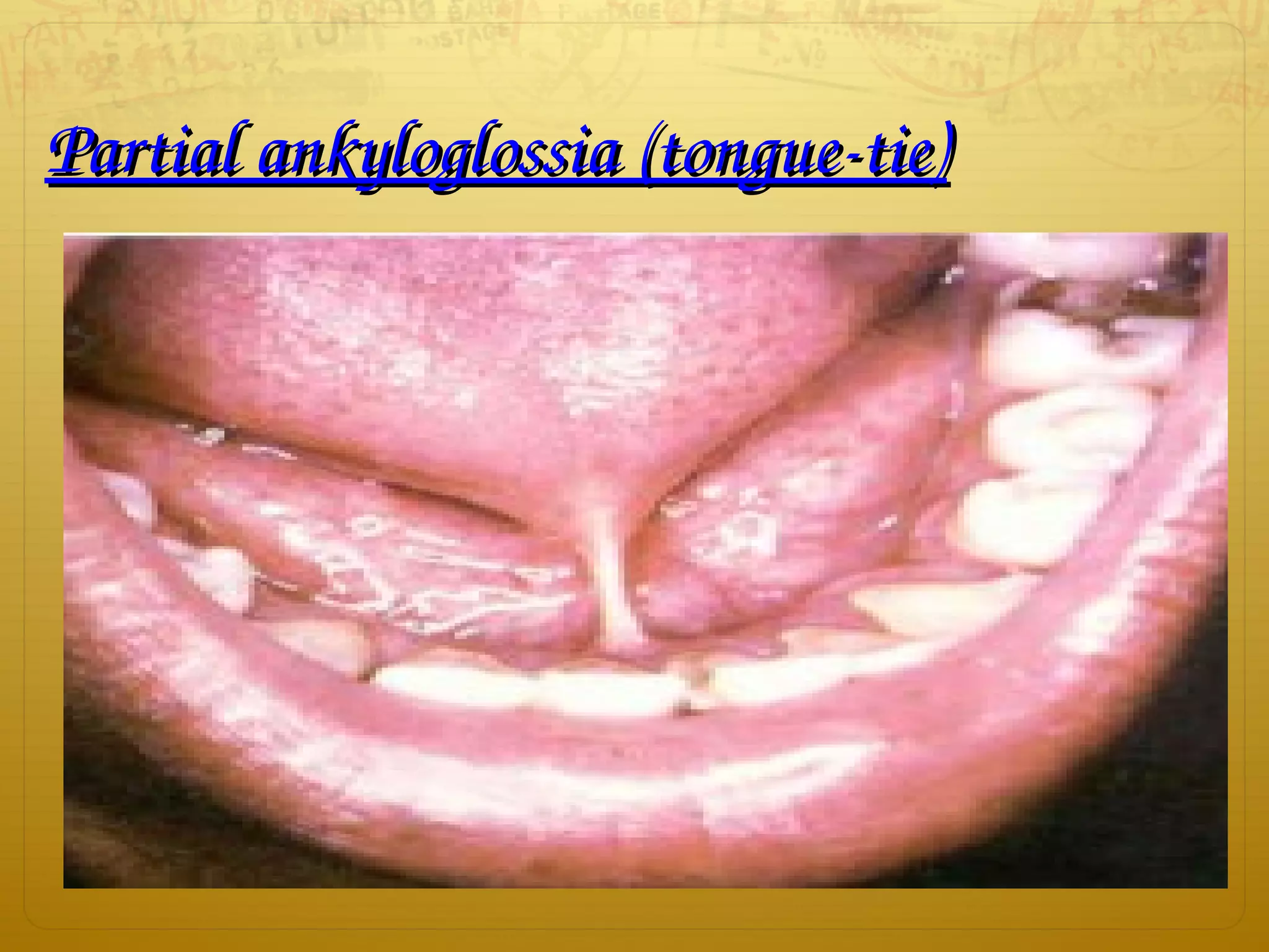 Partial ankyloglossia (tongue­tie)Partial ankyloglossia (tongue­tie)
 