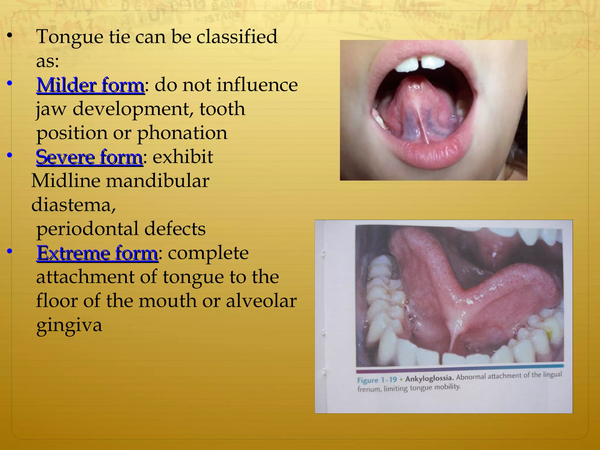 • Tongue tie can be classified
as:
• Milder formMilder form: do not influence
jaw development, tooth
position or phonation
• Severe formSevere form: exhibit
Midline mandibular
diastema,
periodontal defects
• Extreme formExtreme form: complete
attachment of tongue to the
floor of the mouth or alveolar
gingiva
 