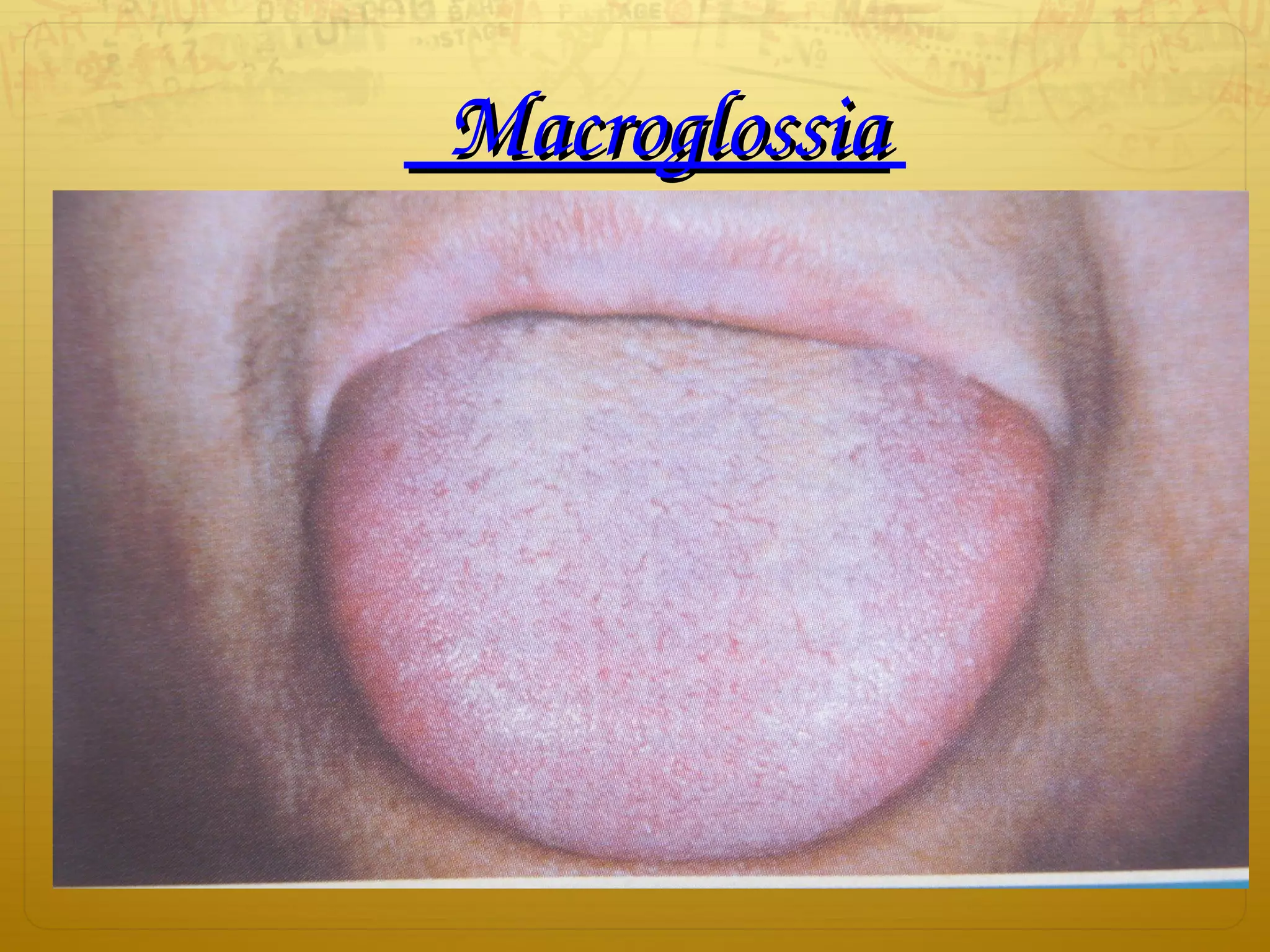     MacroglossiaMacroglossia 
 