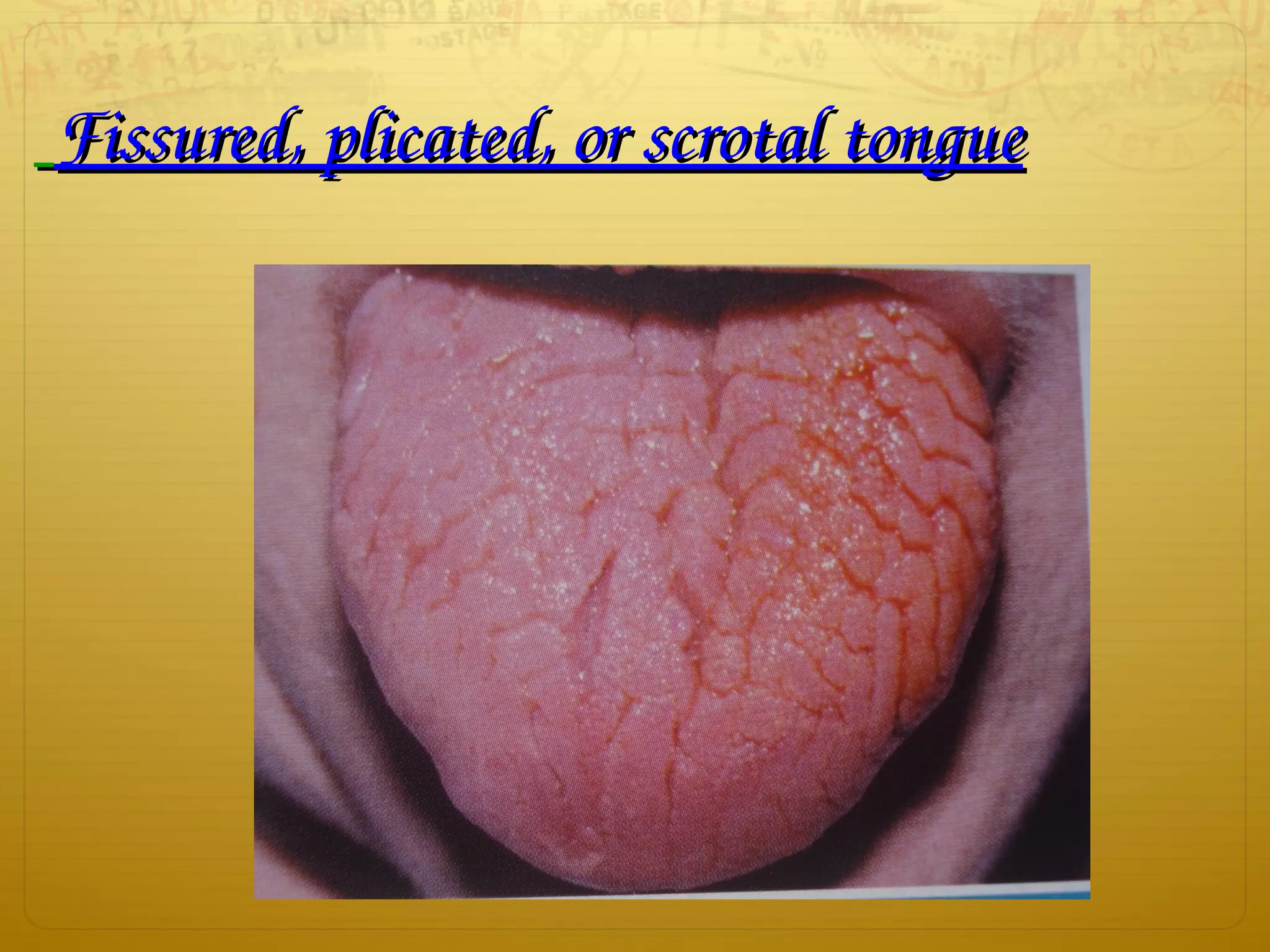 Fissured, plicated, or scrotal tongueFissured, plicated, or scrotal tongue
 