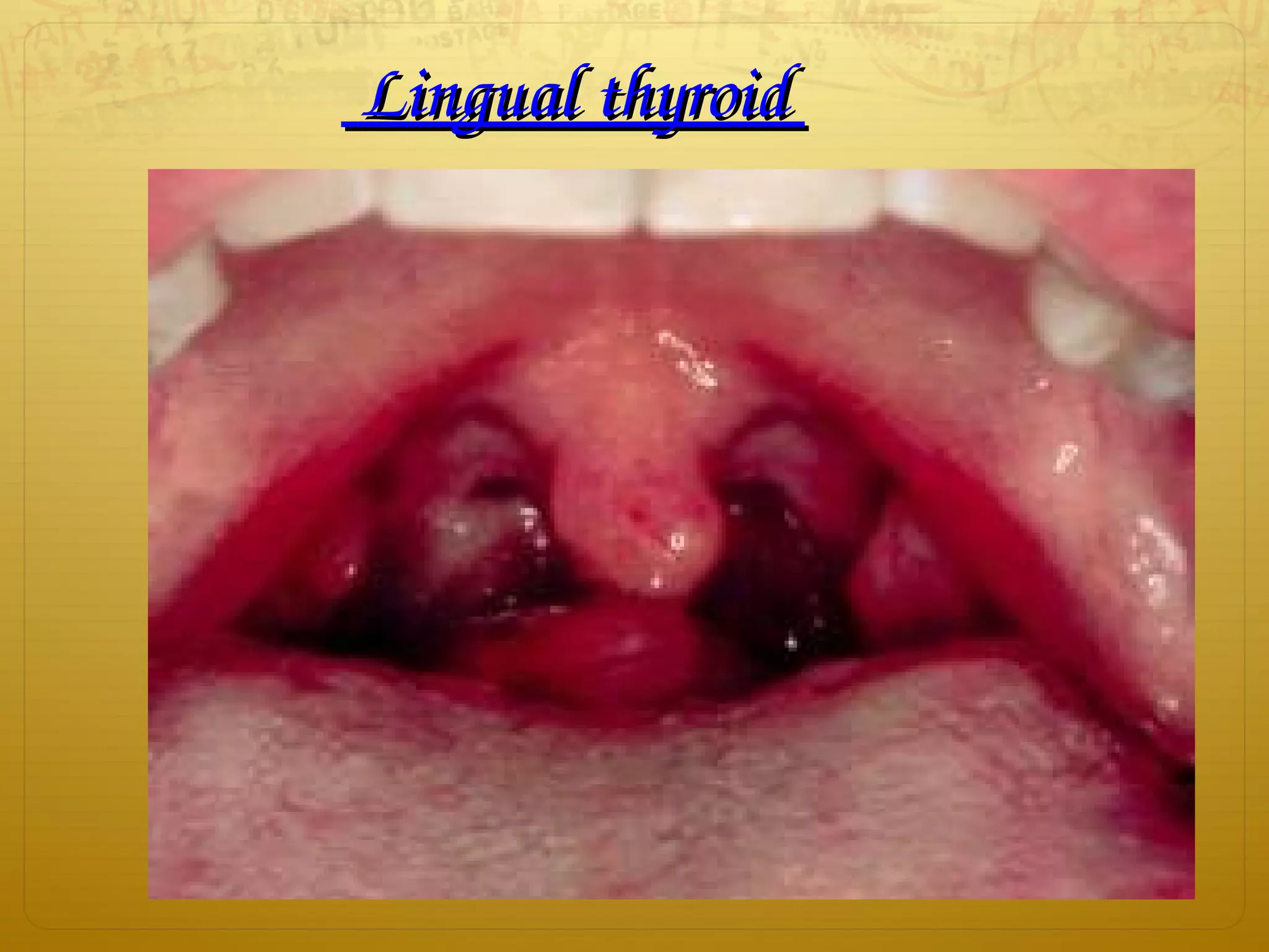   Lingual thyroid Lingual thyroid 
 