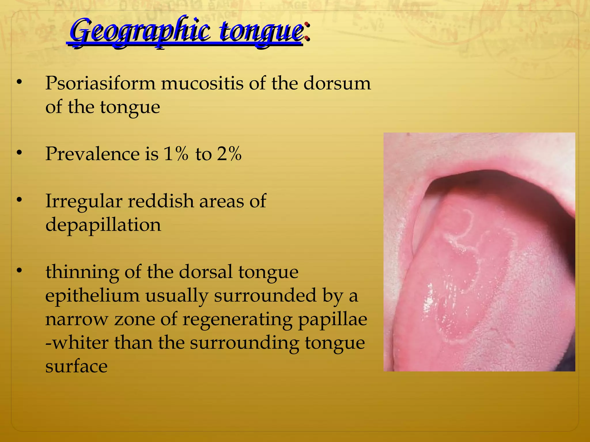 Geographic tongueGeographic tongue::
• Psoriasiform mucositis of the dorsum
of the tongue
• Prevalence is 1% to 2%
• Irregular reddish areas of
depapillation
• thinning of the dorsal tongue
epithelium usually surrounded by a
narrow zone of regenerating papillae
-whiter than the surrounding tongue
surface
 