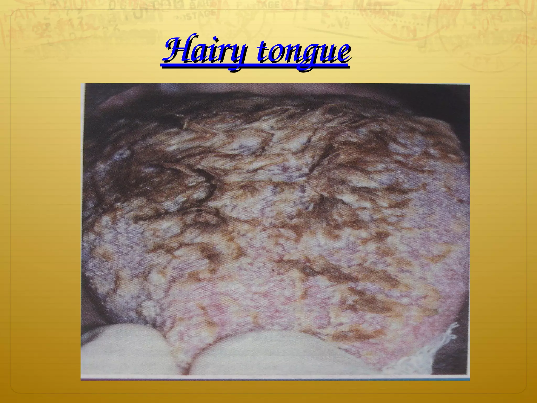 Hairy tongueHairy tongue
 