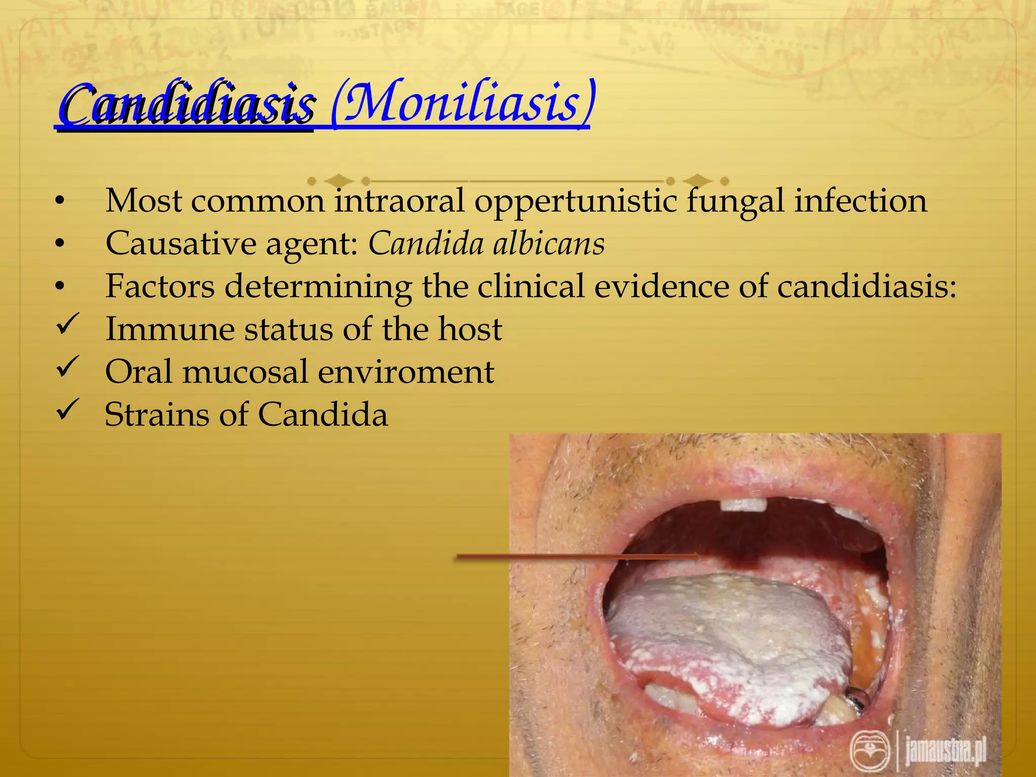 CandidiasisCandidiasis (Moniliasis)
• Most common intraoral oppertunistic fungal infection
• Causative agent: Candida albicans
• Factors determining the clinical evidence of candidiasis:
 Immune status of the host
 Oral mucosal enviroment
 Strains of Candida
 