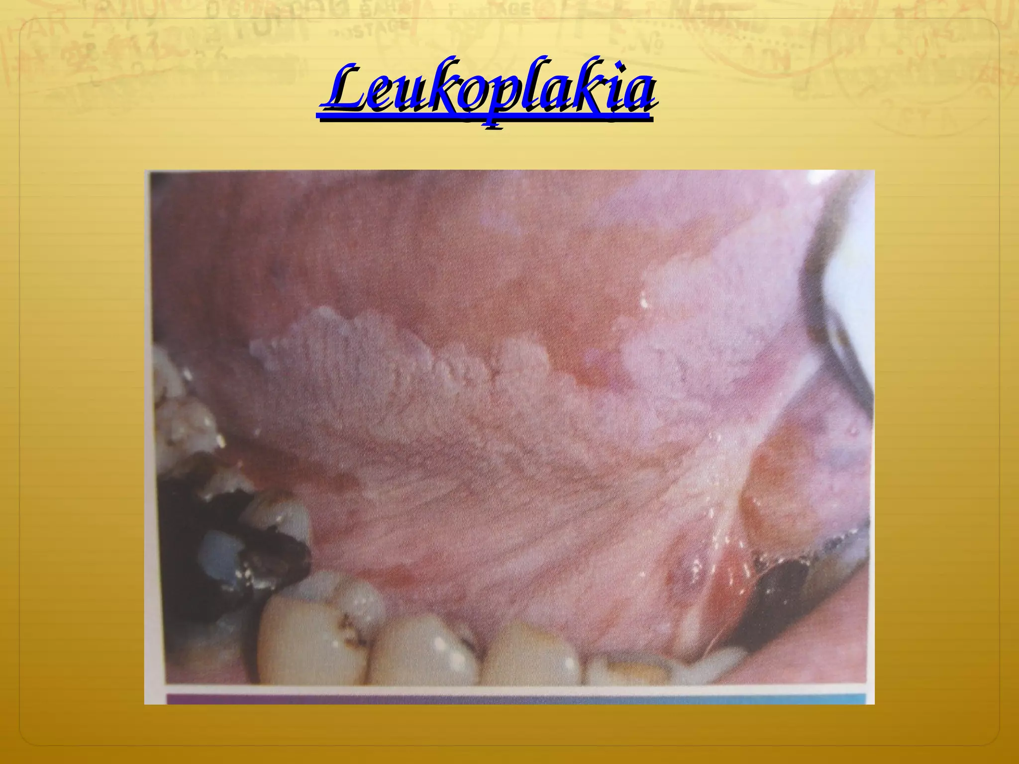 LeukoplakiaLeukoplakia
 