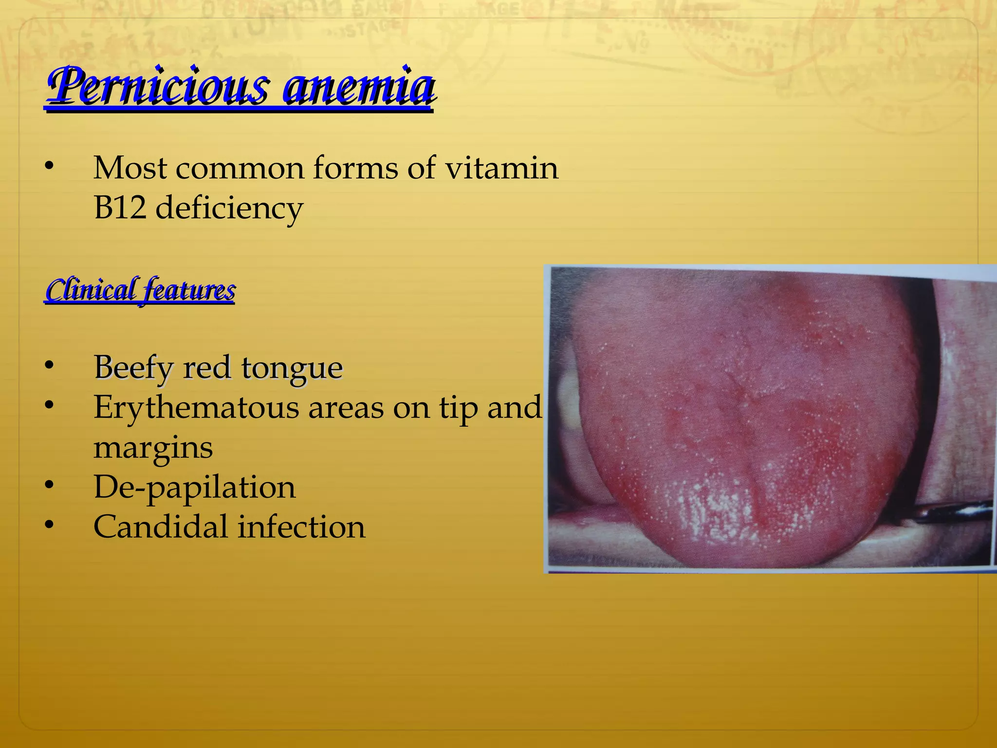 Pernicious anemiaPernicious anemia
• Most common forms of vitamin
B12 deficiency
Clinical featuresClinical features
• Beefy red tongueBeefy red tongue
• Erythematous areas on tip and
margins
• De-papilation
• Candidal infection
 