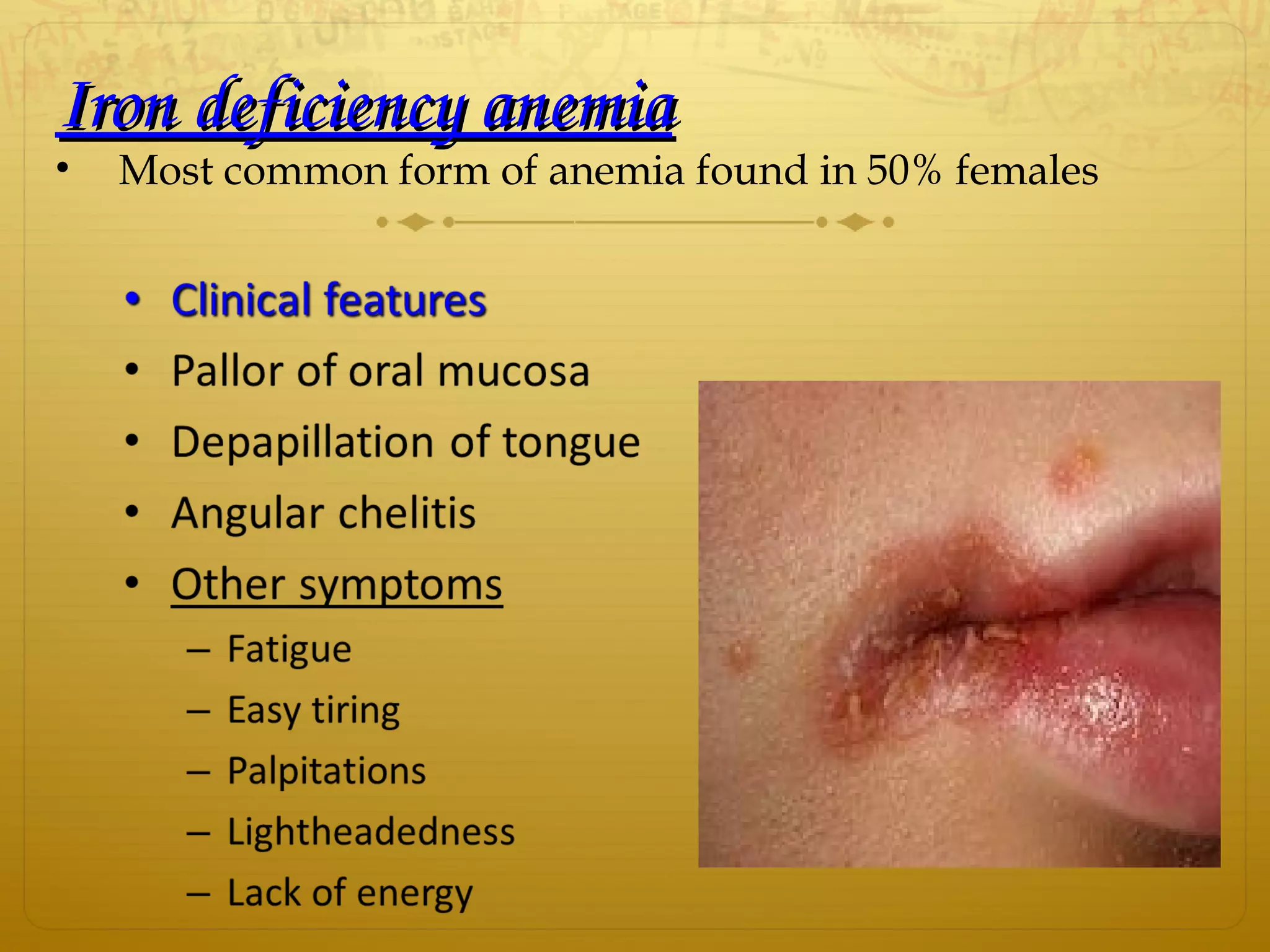 Iron deficiency anemiaIron deficiency anemia
• Most common form of anemia found in 50% females
 