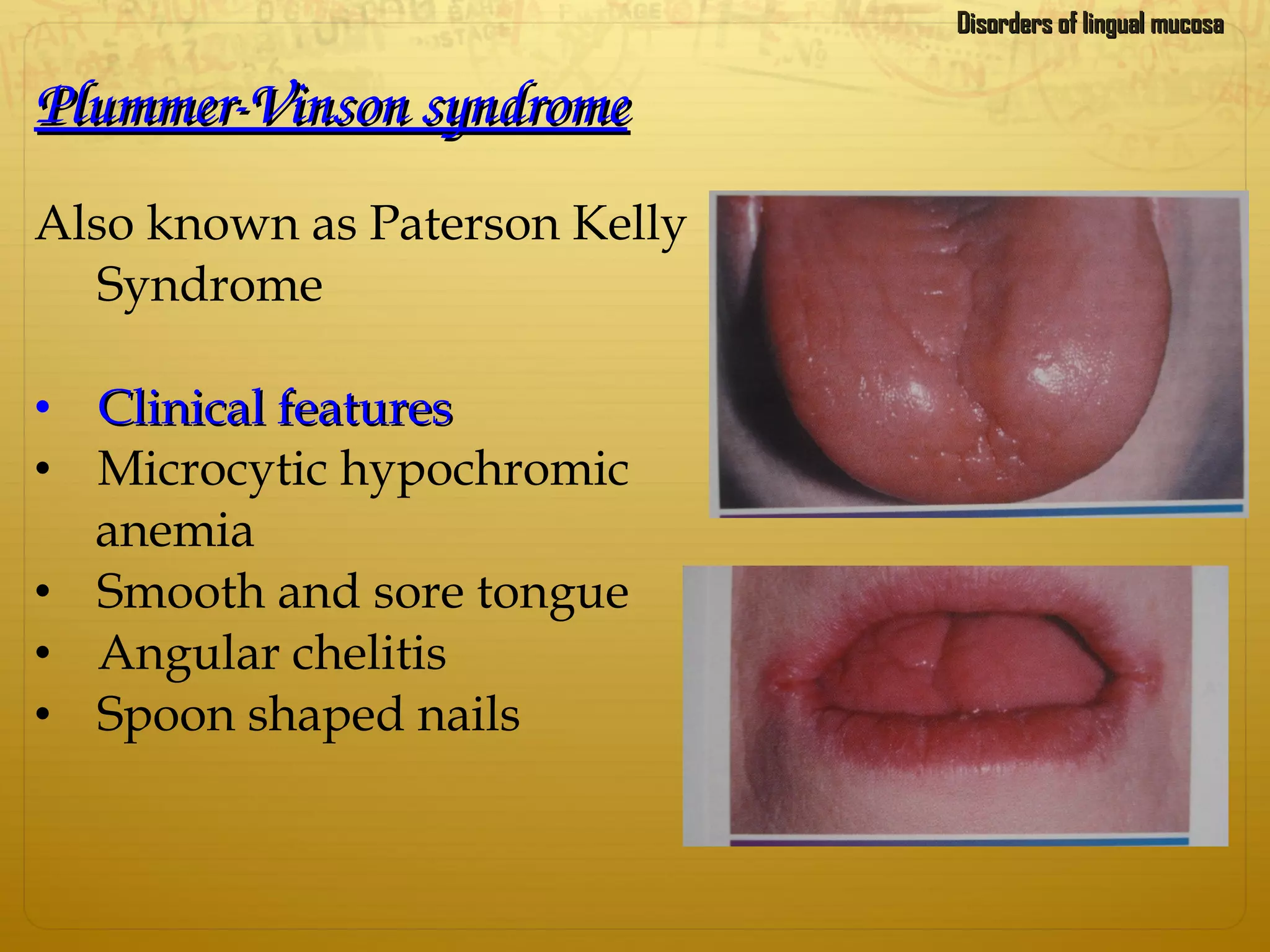 Plummer­Vinson syndromePlummer­Vinson syndrome
Also known as Paterson Kelly
Syndrome
• Clinical featuresClinical features
• Microcytic hypochromic
anemia
• Smooth and sore tongue
• Angular chelitis
• Spoon shaped nails
Disorders of lingual mucosaDisorders of lingual mucosa
 