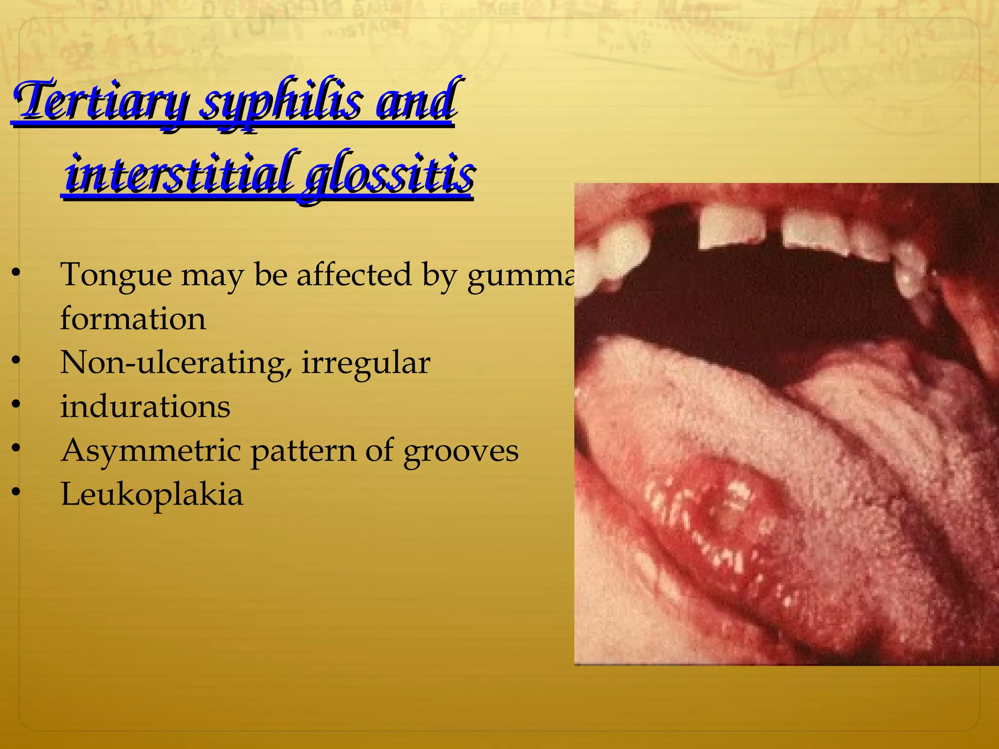 Tertiary syphilis and Tertiary syphilis and 
interstitial glossitisinterstitial glossitis
• Tongue may be affected by gumma
formation
• Non-ulcerating, irregular
• indurations
• Asymmetric pattern of grooves
• Leukoplakia
 