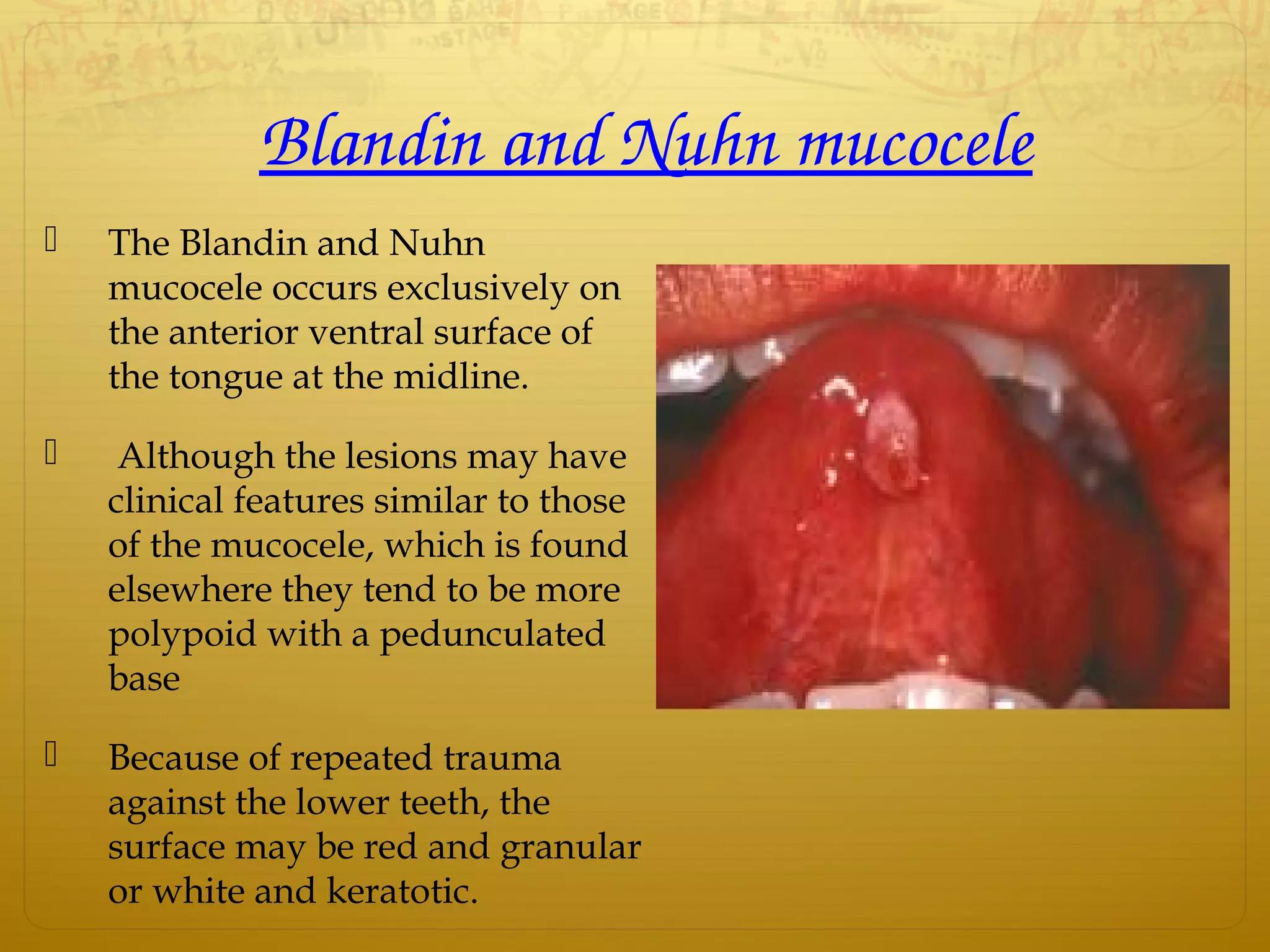Blandin and Nuhn mucocele
 The Blandin and Nuhn
mucocele occurs exclusively on
the anterior ventral surface of
the tongue at the midline.
 Although the lesions may have
clinical features similar to those
of the mucocele, which is found
elsewhere they tend to be more
polypoid with a pedunculated
base
 Because of repeated trauma
against the lower teeth, the
surface may be red and granular
or white and keratotic.
 