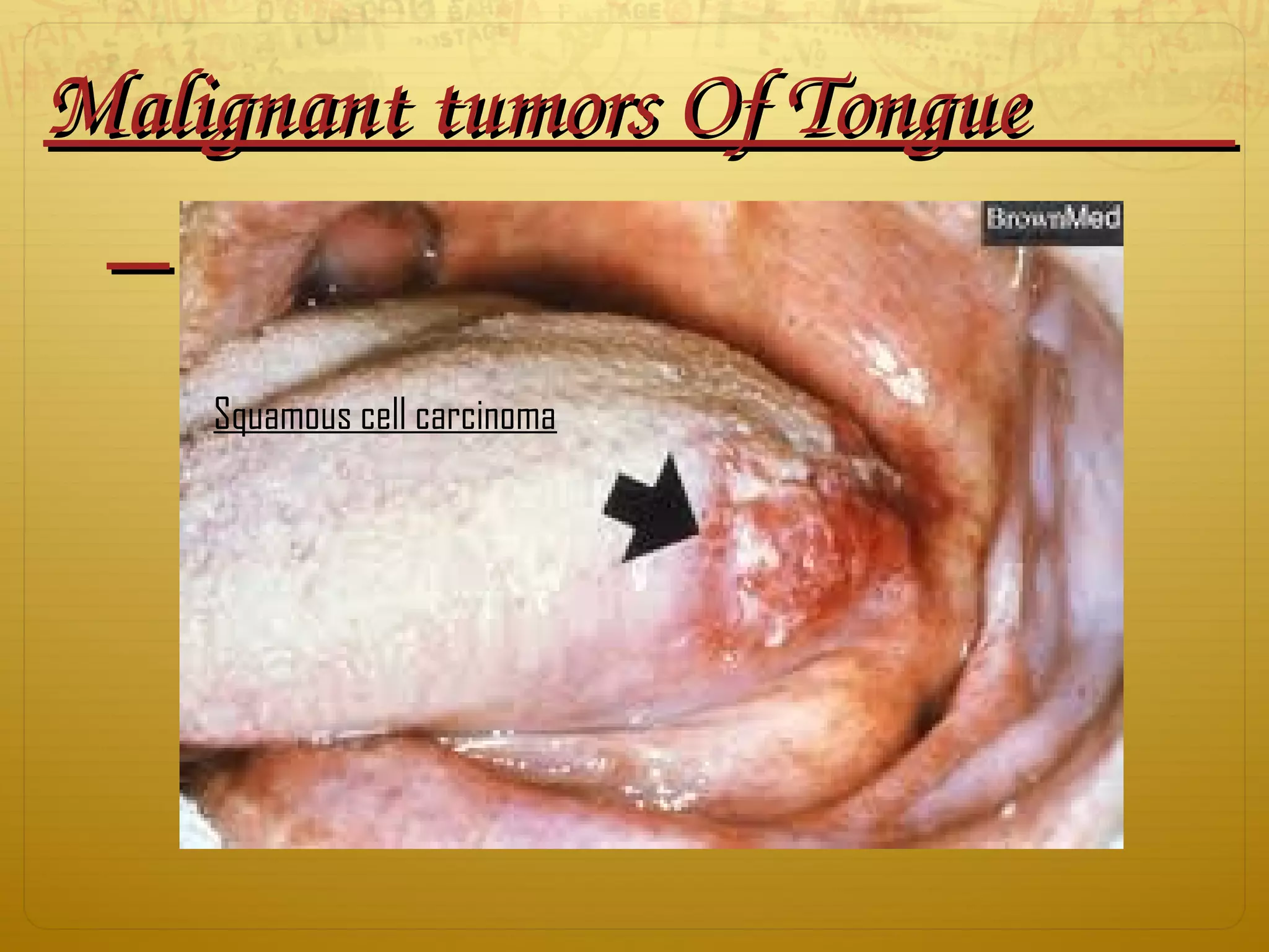 Malignant tumors Of Tongue           Malignant tumors Of Tongue           
      
Squamous cell carcinoma
 