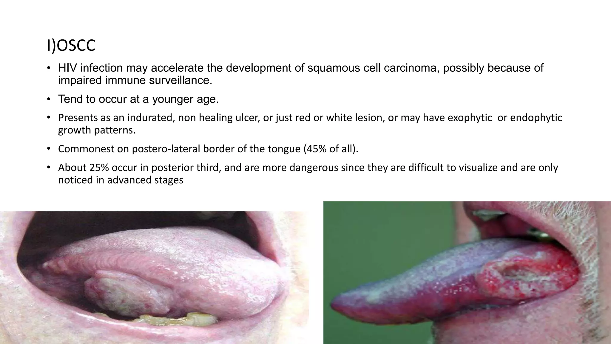 I)OSCC
• HIV infection may accelerate the development of squamous cell carcinoma, possibly because of
impaired immune surveillance.
• Tend to occur at a younger age.
• Presents as an indurated, non healing ulcer, or just red or white lesion, or may have exophytic or endophytic
growth patterns.
• Commonest on postero-lateral border of the tongue (45% of all).
• About 25% occur in posterior third, and are more dangerous since they are difficult to visualize and are only
noticed in advanced stages
 