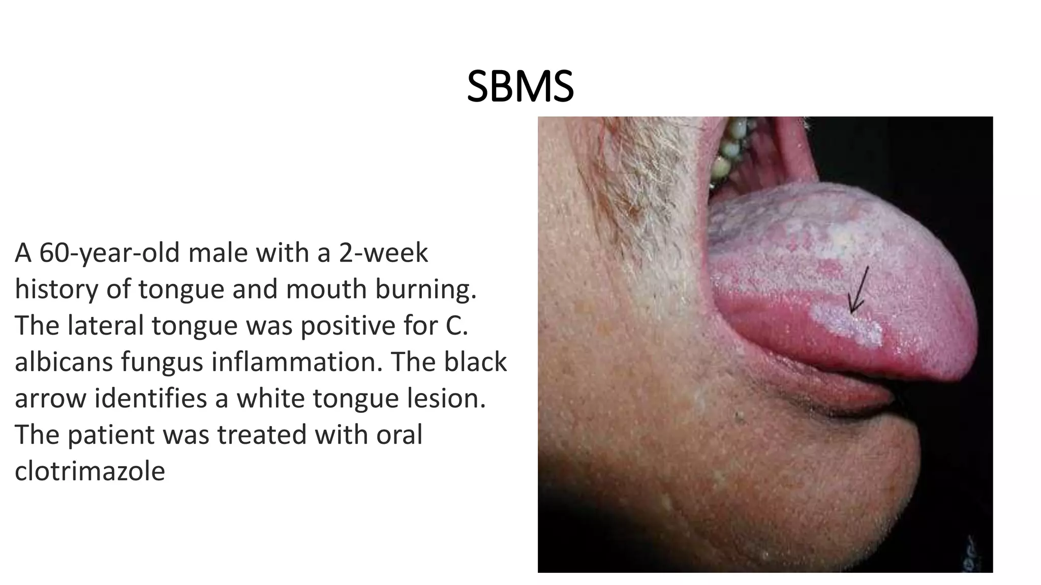 SBMS
A 60-year-old male with a 2-week
history of tongue and mouth burning.
The lateral tongue was positive for C.
albicans fungus inflammation. The black
arrow identifies a white tongue lesion.
The patient was treated with oral
clotrimazole
 