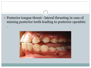  Posterior tongue thrust : lateral thrusting in case of
missing posterior teeth leading to posterior openbite
.
 
