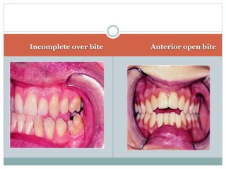Incomplete over bite Anterior open bite
 