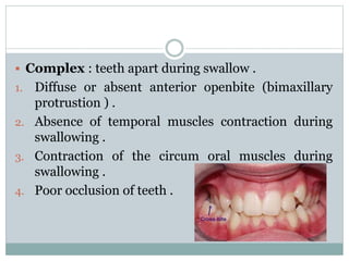  Complex : teeth apart during swallow .
1. Diffuse or absent anterior openbite (bimaxillary
protrustion ) .
2. Absence of temporal muscles contraction during
swallowing .
3. Contraction of the circum oral muscles during
swallowing .
4. Poor occlusion of teeth .
 