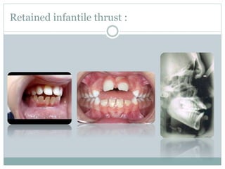 Retained infantile thrust :
 