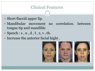 Clinical Features
 Short flaccid upper lip.
 Mandibular movement no correlation. between
tongue tip and mandible
 Speech : s , n , d , I , z, v , th.
 Increase the anterior facial hight .
 