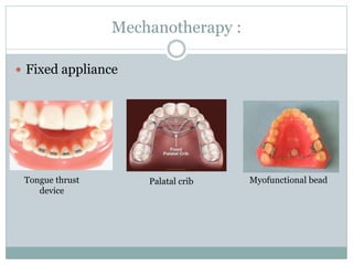 Mechanotherapy :
 Fixed appliance
Tongue thrust
device
Palatal crib Myofunctional bead
 