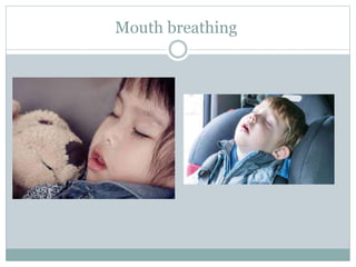 Mouth breathing
 