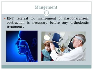 Mangement
 ENT referral for mangement of nasopharyngeal
obstruction is necessary before any orthodontic
treatment .
 