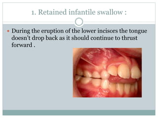 1. Retained infantile swallow :
 During the eruption of the lower incisors the tongue
doesn’t drop back as it should continue to thrust
forward .
 