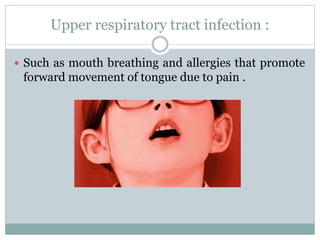 Upper respiratory tract infection :
 Such as mouth breathing and allergies that promote
forward movement of tongue due to pain .
 
