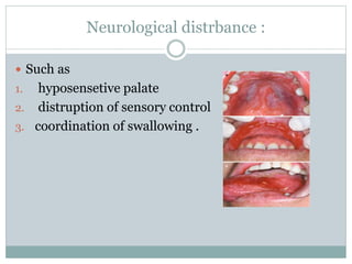 Neurological distrbance :
 Such as
1. hyposensetive palate
2. distruption of sensory control
3. coordination of swallowing .
 