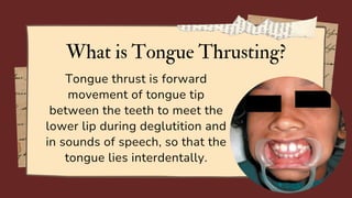 What is Tongue Thrusting?
Tongue thrust is forward
movement of tongue tip
between the teeth to meet the
lower lip during deglutition and
in sounds of speech, so that the
tongue lies interdentally.
 