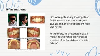 Before treatment:
Lips were potentially incompetent,
facial pattern was convex (Figure
1a,b&c) and anterior divergent face
was noted.
Futhermore, he presented class II
molars relationship, an increased
overjet (+8mm) and deep overbite
(+3mm)
 