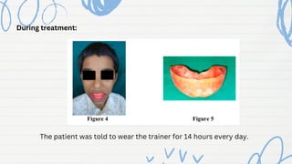 During treatment:
The patient was told to wear the trainer for 14 hours every day.
 
