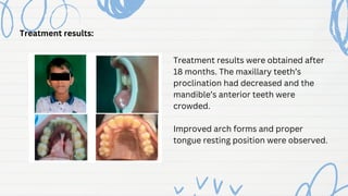 Treatment results:
Treatment results were obtained after
18 months. The maxillary teeth’s
proclination had decreased and the
mandible’s anterior teeth were
crowded.
Improved arch forms and proper
tongue resting position were observed.
 