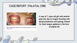 CASEREPORT:PALATALCRIB
A case of 7 years old girl with anterior
open bite due to tongue thrusting with
dental proclination and spacing, treated
by fixed tongue appliance in the form
of palatal crib
 