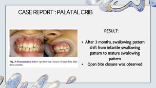 CASEREPORT:PALATALCRIB
RESULT:
After 3 months, swallowing pattern
shift from infantile swallowing
pattern to mature swallowing
pattern
Open bite closure was observed
 