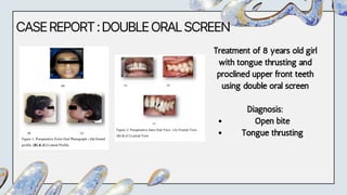 CASEREPORT:DOUBLEORALSCREEN
Treatment of 8 years old girl
with tongue thrusting and
proclined upper front teeth
using double oral screen
Diagnosis:
Open bite
Tongue thrusting
 