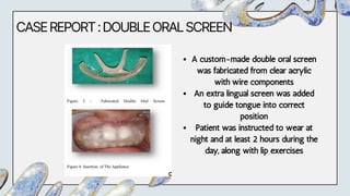 CASEREPORT:DOUBLEORALSCREEN
A custom-made double oral screen
was fabricated from clear acrylic
with wire components
An extra lingual screen was added
to guide tongue into correct
position
Patient was instructed to wear at
night and at least 2 hours during the
day, along with lip exercises
 