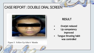 CASEREPORT:DOUBLEORALSCREEN
RESULT
Overjet reduced
Lip competency
improved
Tongue thrusting habit
was controlled
 