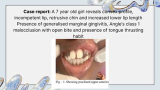 Case report: A 7 year old girl reveals convex profile,
incompetent lip, retrusive chin and increased lower lip length
Presence of generalised marginal gingivitis, Angle’s class 1
malocclusion with open bite and presence of tongue thrusting
habit
 