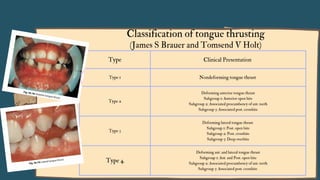 Type Clinical Presentation
Type 1 Nondeforming tongue thrust
Type 2
Deforming anterior tongue thrust
Subgroup 1: Anterior open bite
Subgroup 2: Associated procumbency of ant. teeth
Subgroup 3: Associated post. crossbite
Type 3
Deforming lateral tongue thrust
Subgroup 1: Post. open bite
Subgroup 2: Post. crossbite
Subgroup 3: Deep overbite
Type 4
Deforming ant. and lateral tongue thrust
Subgroup 1: Ant. and Post. open bite
Subgroup 2: Associated procumbency of ant. teeth
Subgroup 3: Associated post. crossbite
Classification of tongue thrusting
(James S Brauer and Tomsend V Holt)
 