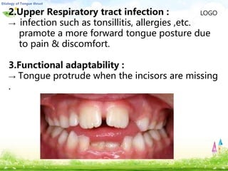 LOGO2.Upper Respiratory tract infection :
→ infection such as tonsillitis, allergies ,etc.
pramote a more forward tongue posture due
to pain & discomfort.
3.Functional adaptability :
→ Tongue protrude when the incisors are missing
.
 