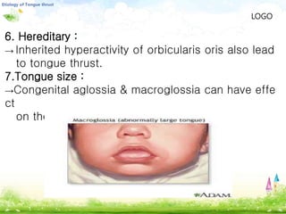 LOGO
6. Hereditary :
→ Inherited hyperactivity of orbicularis oris also lead
to tongue thrust.
7.Tongue size :
→Congenital aglossia & macroglossia can have effe
ct
on the dentition.
 