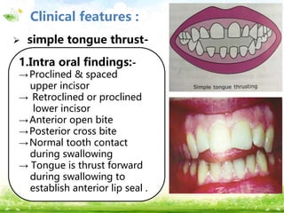 LOGOClinical features :
1.Extra oral findings
 Lip posture -
 simple tongue thrust-
1.Intra oral findings:-
→Proclined & spaced
upper incisor
→ Retroclined or proclined
lower incisor
→Anterior open bite
→Posterior cross bite
→Normal tooth contact
during swallowing
→ Tongue is thrust forward
during swallowing to
establish anterior lip seal .
 
