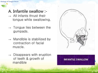 LOGO
A. Infantile swallow :-
→ All infants thrust their
tongue while swallowing.
→ Tongue lies between the
gumpads.
→ Mandible is stabilized by
contraction of facial
muscle.
→ Disappears with eruption
of teeth & growth of
mandible
 
