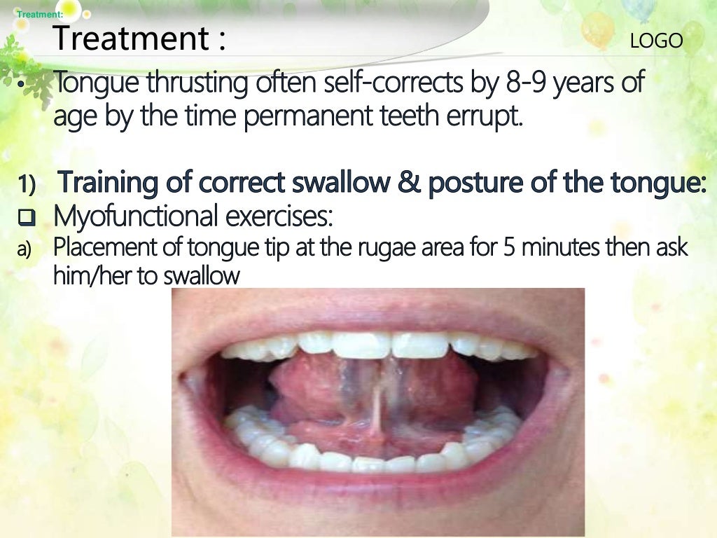 TONGUE THRUSTING HABIT