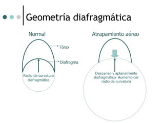 Geometría diafragmática Diafragma Tórax Radio de curvatura diafragmática Normal Atrapamiento aéreo Descenso y aplanamiento diafragmático: Aumento del radio de curvatura 