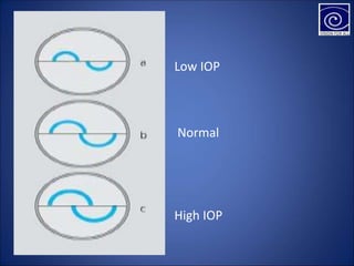 Low IOP
Normal
High IOP
 