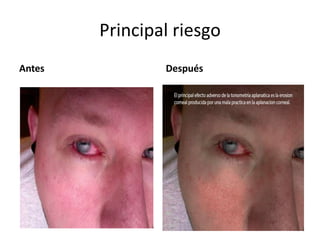 Principal riesgo
Antes Después