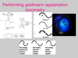Performing goldmann applanation
tonometry
 