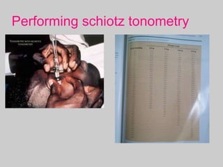 Performing schiotz tonometry
 